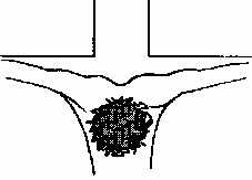 crucifié